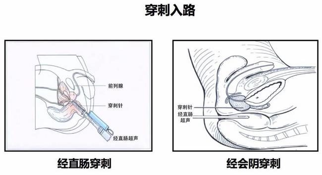 蕪湖市中醫(yī)醫(yī)院首次開展超聲引導(dǎo)下經(jīng)會陰前列腺穿刺(圖1)