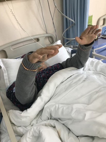 我院卒中中心救治團(tuán)隊(duì)成功為一例高齡重癥腦卒中 患者行腦血管介入取栓手術(shù)(圖3)