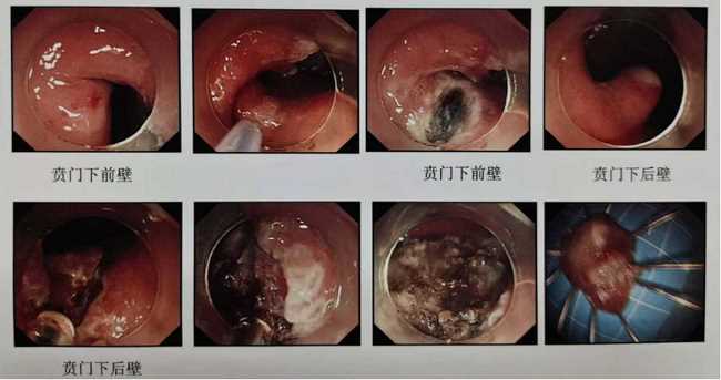 炎夏漸至，“胃腸”已碌 ——狹小的空間見證消化內(nèi)鏡微創(chuàng)手術(shù)的魅力(圖2)