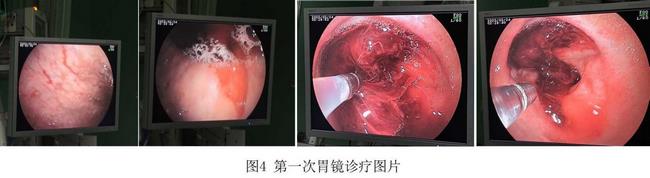 癡呆老人命懸一線，內(nèi)鏡止血彰顯奇功(圖2)