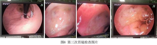 癡呆老人命懸一線，內(nèi)鏡止血彰顯奇功(圖4)