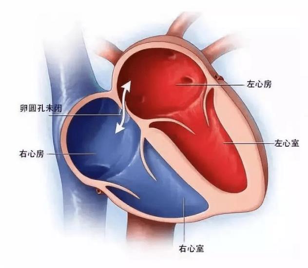探尋不明原因卒中、偏頭痛根源的檢查技術(shù)—TCD發(fā)泡試驗(yàn)(圖1)