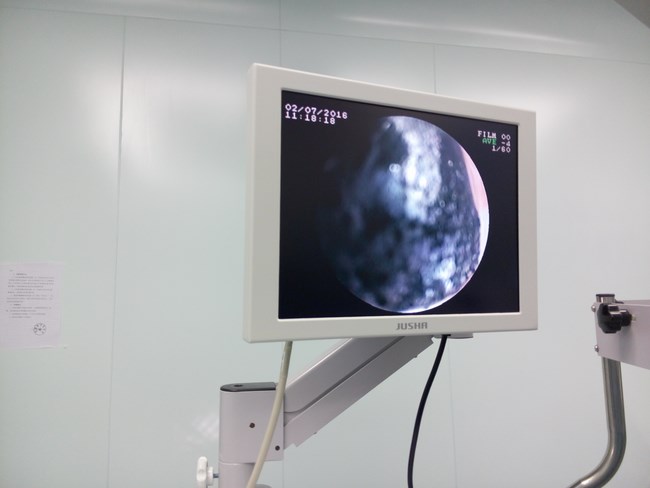 我院開展第一例腹腔鏡下膽總管切開取石術(shù)(圖2)