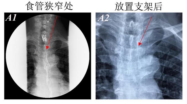消化科運用多學(xué)科會診（MDT）微創(chuàng)診治食管惡性腫瘤侵潤所致食、氣道梗阻(圖4)