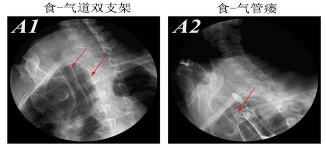 消化科運用多學(xué)科會診（MDT）微創(chuàng)診治食管惡性腫瘤侵潤所致食、氣道梗阻(圖8)