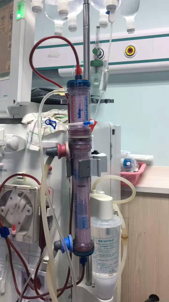 我院血透中心完成安徽省首例尿毒癥患者雙腔血液透析濾過(guò)（PHF）術(shù)(圖2)