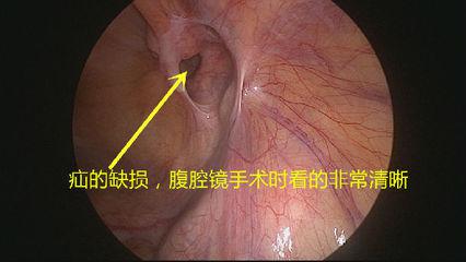 切口小，當(dāng)天即可生活自理——外三科開展腹腔鏡下疝氣手術(shù)(圖1)