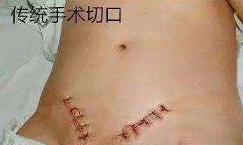 切口小，當(dāng)天即可生活自理——外三科開展腹腔鏡下疝氣手術(shù)(圖4)