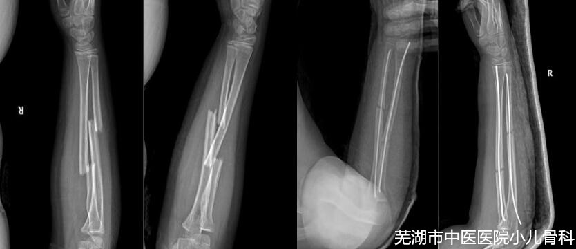 兒童健康的守護(hù)者——蕪湖市中醫(yī)醫(yī)院兒童骨科(圖3)