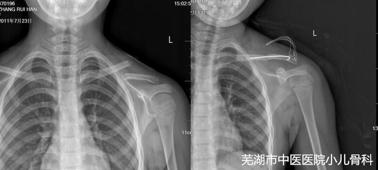 兒童健康的守護(hù)者——蕪湖市中醫(yī)醫(yī)院兒童骨科(圖6)